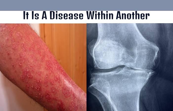 Five Things You Should Know About Psoriatic Arthritis 