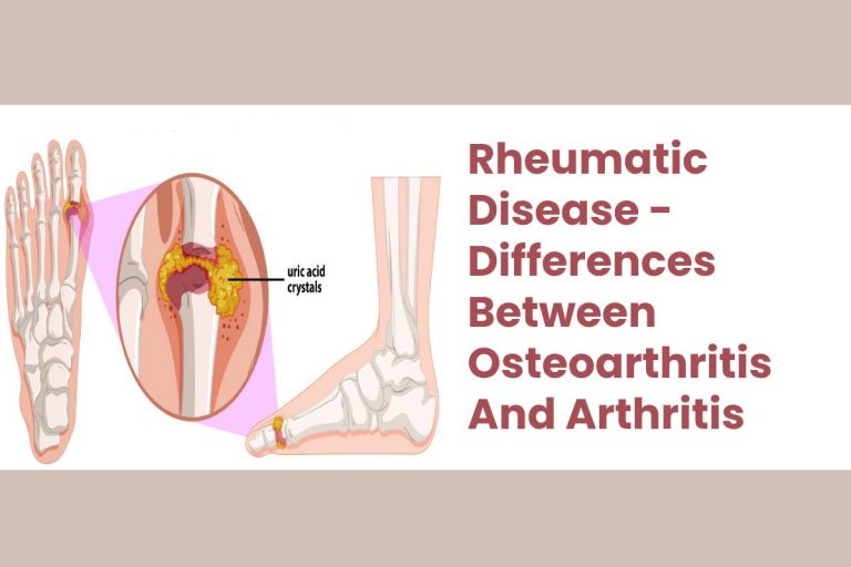 Rheumatic Disease: Differences Between Osteoarthritis & Arthritis