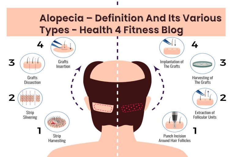 Alopecia – Definition And Its Various Types