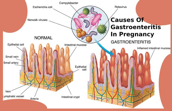 signs-and-symptoms-of-viral-gastroenteritis-jaipur-gastro-clinic