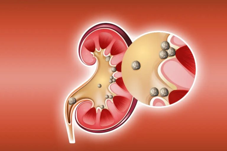 Eliminate Kidney Stones With 5 Natural Remedies