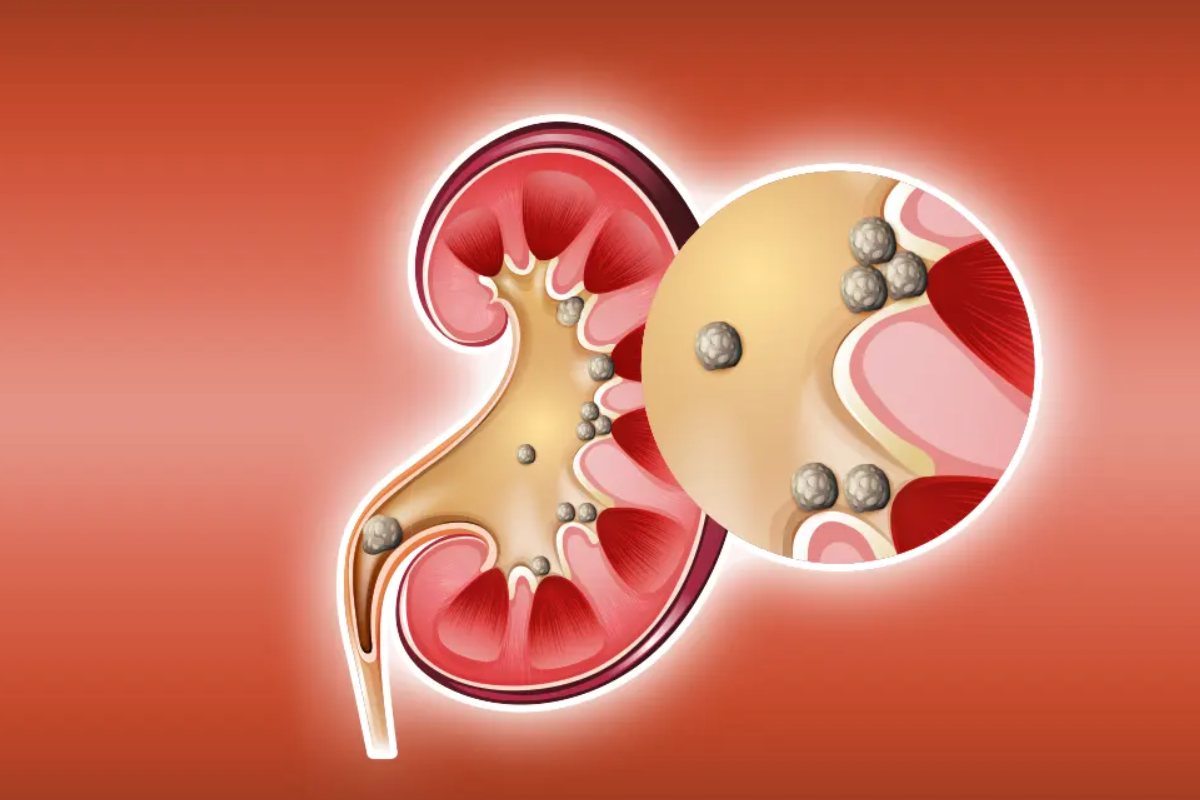 Kidney Stones