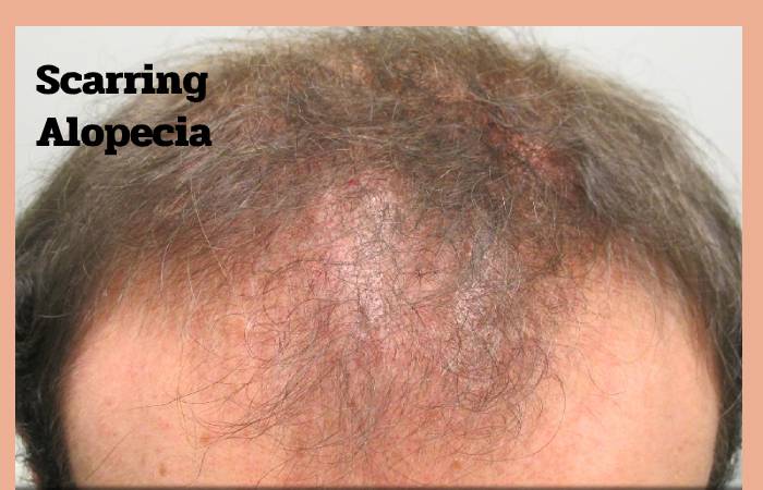 Scarring Alopecia