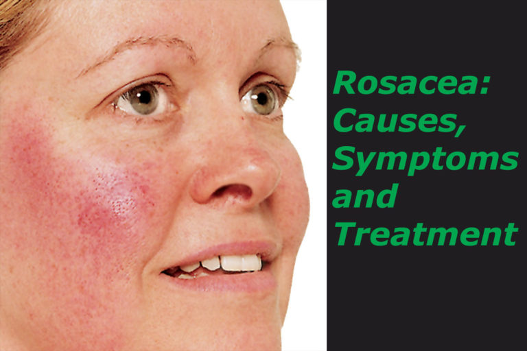 Rosacea: Causes, Symptoms and Treatments