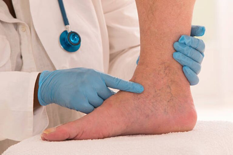 Sclerotherapy Treatment For Spider Veins