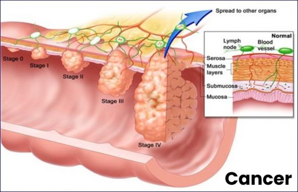 how bad is stage 4 cancer