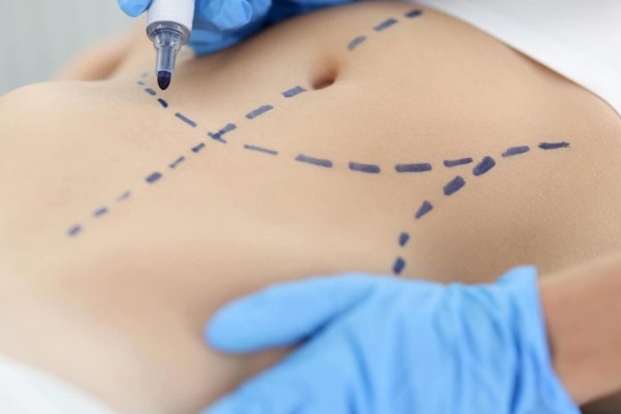 Liposuction Pubic Area