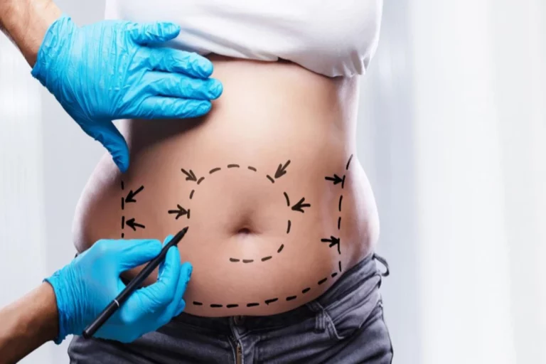 The Definitive Guide to Tummy Tuck cost in Louisiana