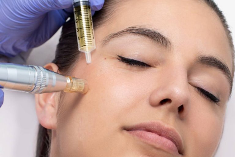 What Does Microneedling With Vivace Entail?