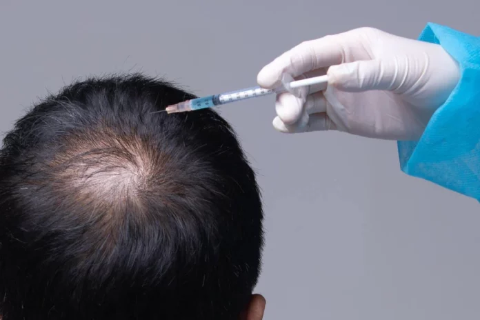 Hair Transplant Cost