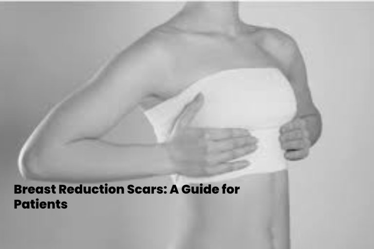 Breast Reduction Scars: A Guide for Patients