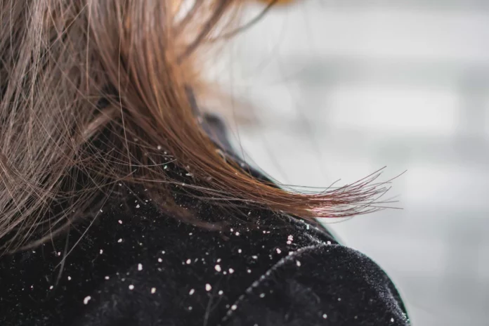 Biggest Dandruff Flake Ever