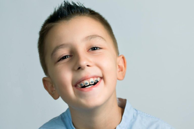 Braces for Kids: A Comprehensive Guide