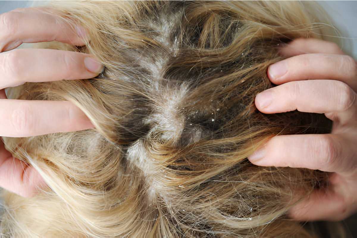 Yeast on your scalp