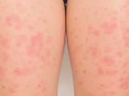 How to Get Rid of Strawberry Legs