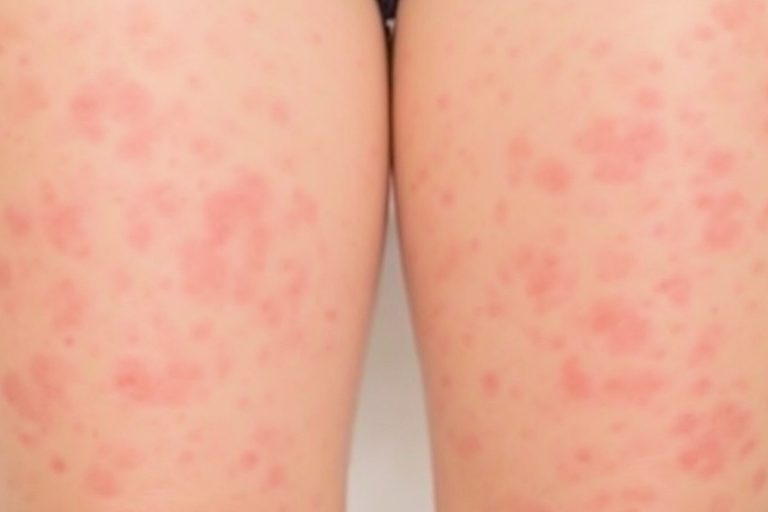 How to Get Rid of Strawberry Legs: A Comprehensive Guide